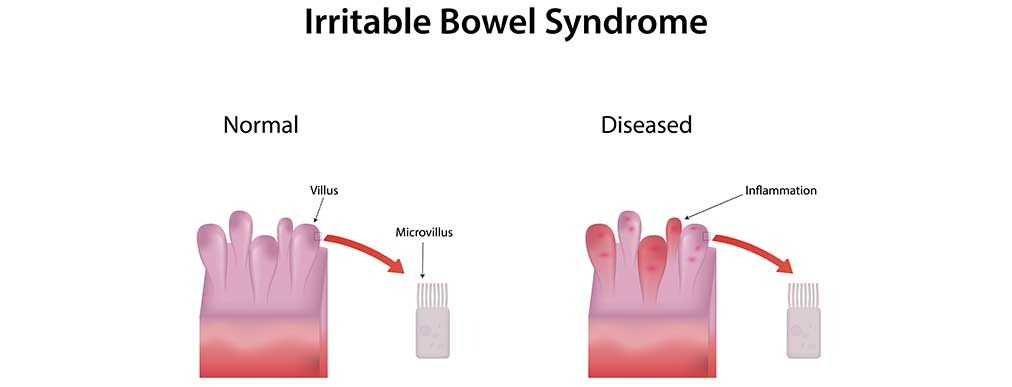 5 Tips to offset possible IBS triggers